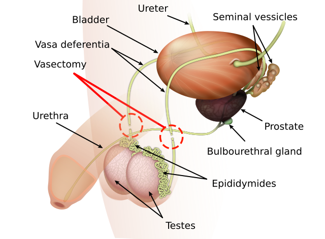 Vasectomy_diagram - Gringo Gazette North